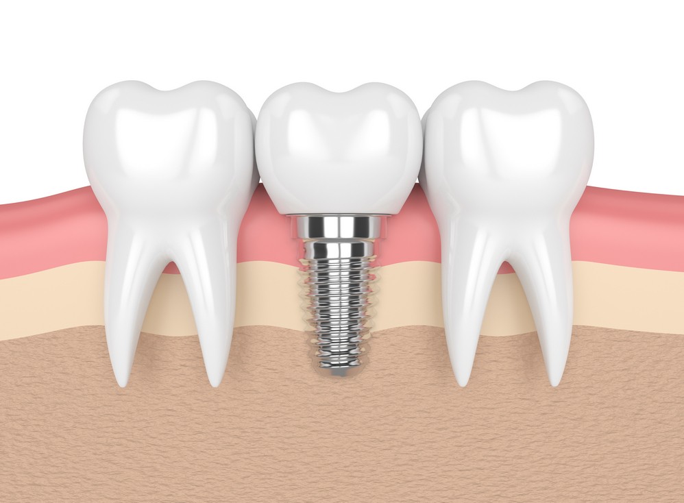 implant dentar, implant dentar bucuresti, implant dentar vitan, implant dentar orto care, pret impla