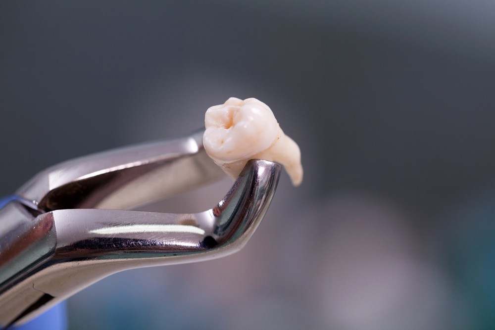 extractie masea de mintebucuresti, extractie molar de minte bucuresti, orto care