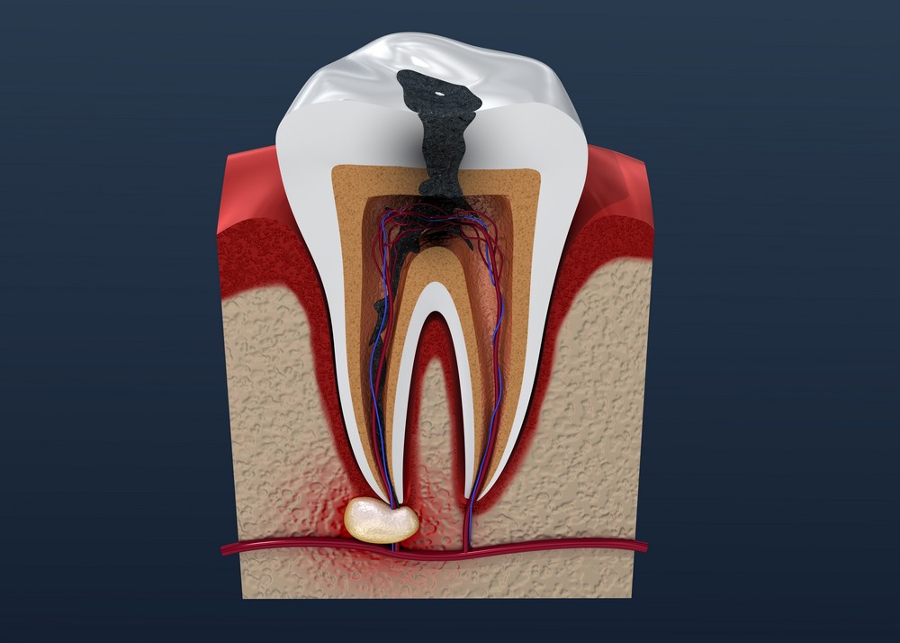 tratament endodontic, obturatie de canal, orto care, stomatologie bucuresti, stomatologie vitan