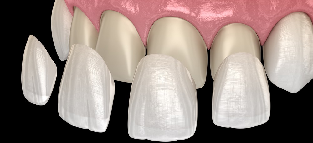 estetica dentara orto care, fatete dentare bucuresti, albire dentara bucuresti