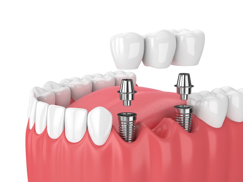 implant dentar bucuresti, implant dentar orto care, implant dentar vitan, implant dentar, orto care