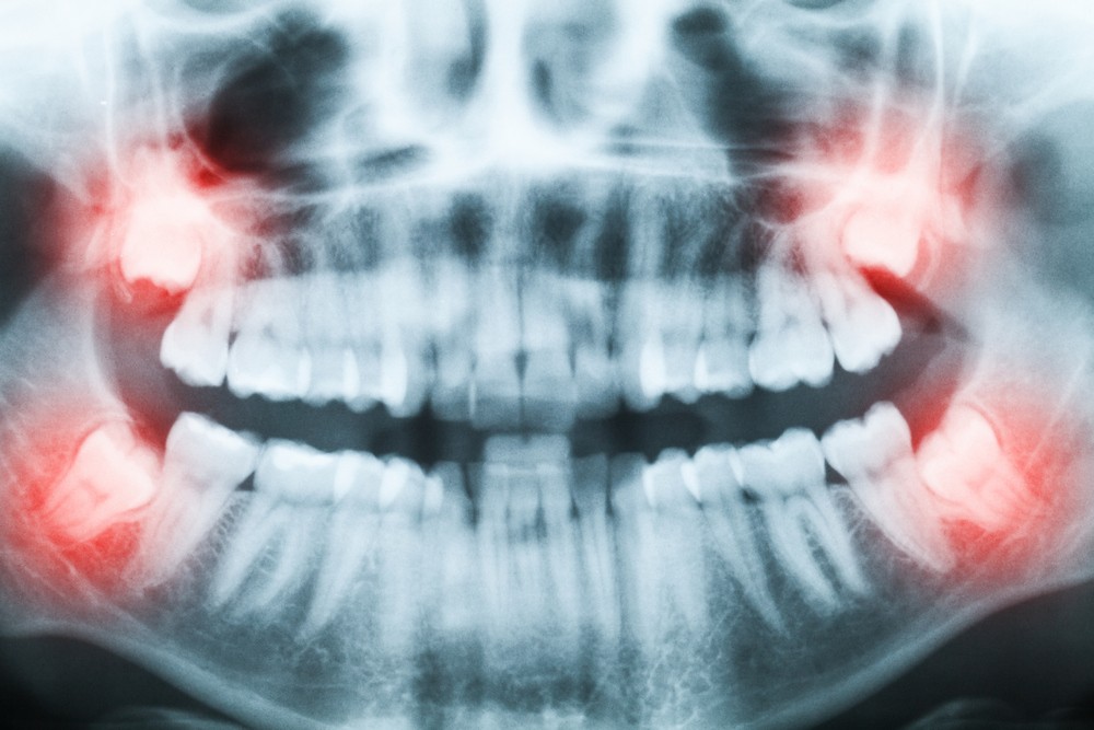 extractie masea de mintebucuresti, extractie molar de minte bucuresti, orto care