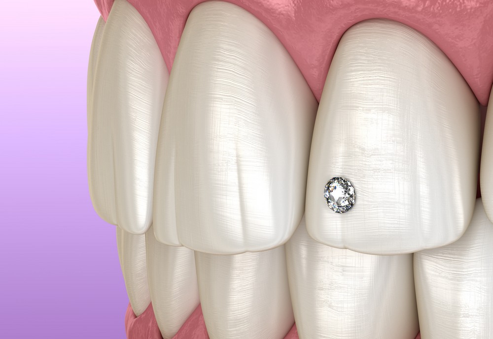 estetica dentara orto care, fatete dentare bucuresti, albire dentara bucuresti